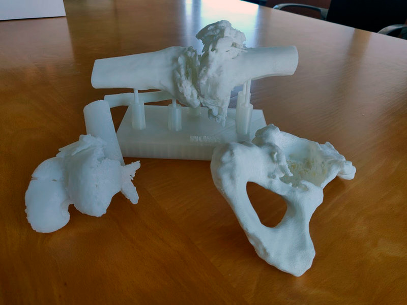 Un model 3D permet fer un estudi preoperatori més acurat. (Foto: SSIBE).