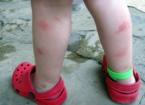 La picada del mosquit tigre és molt irritant.