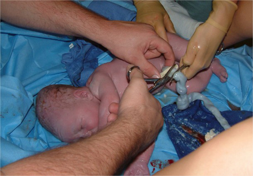 Un nadó acabat de néixer, encara amb el cordó umbilical.