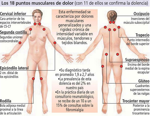 La fibromiàlgia és un dolència difícil de diagnosticar. (Foto: fibromialgiablogatillo)